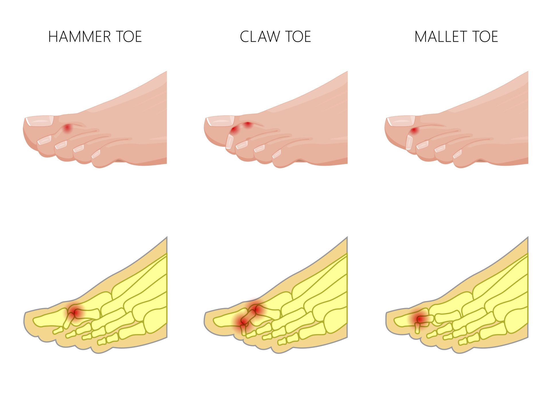 Causes and Treatment of Claw Toe Deformities Okikiko