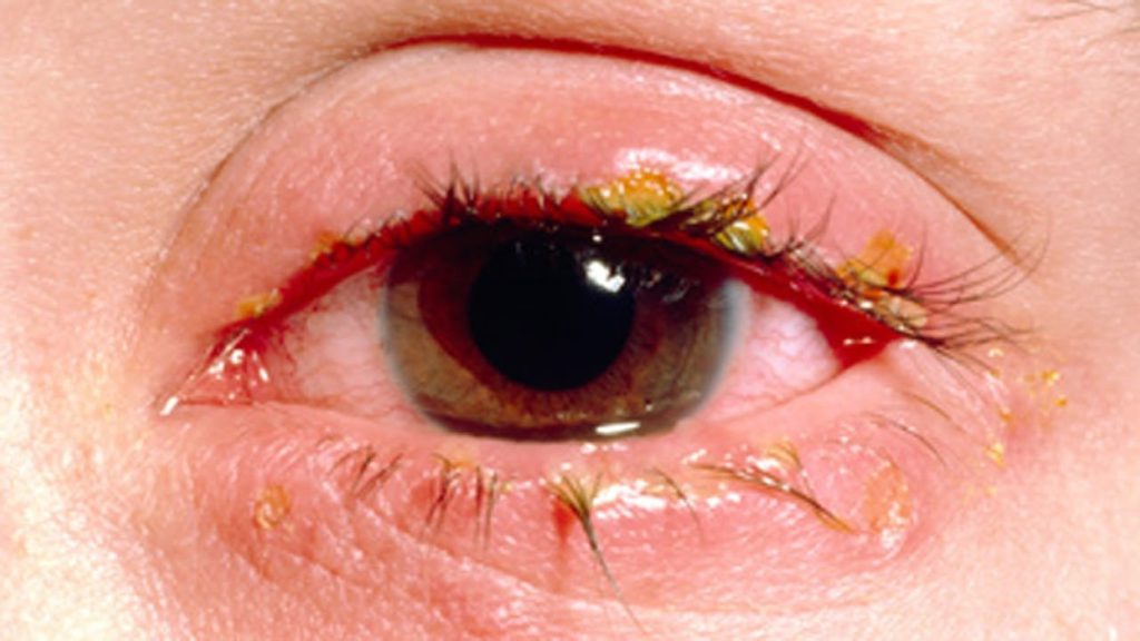 home-remedies-for-crusty-eyelids-okikiko