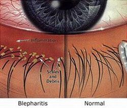 eyelids crusted shut in morning